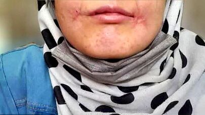 مرد معتاد لب‌های زن ۱۸ ساله‌اش را دوخت| اظهارات تکان‌دهنده فائزه در کلانتری خواجه‌ربیع مشهد