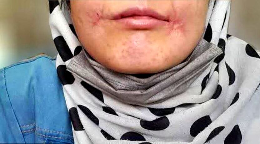 مرد معتاد لب‌های زن ۱۸ ساله‌اش را دوخت| اظهارات تکان‌دهنده فائزه در کلانتری خواجه‌ربیع مشهد