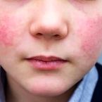 این بیماری در کودکان خطرناک‌تر است | چطور پیشگیری کنیم؟