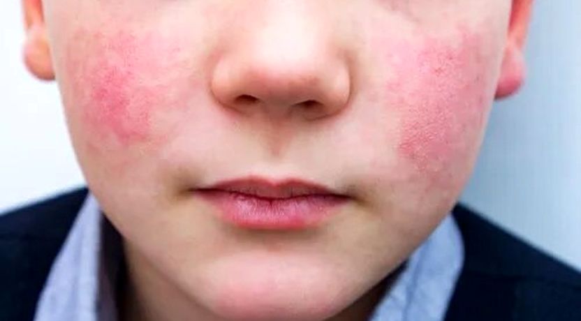 این بیماری در کودکان خطرناک‌تر است | چطور پیشگیری کنیم؟