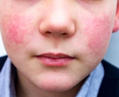 این بیماری در کودکان خطرناک‌تر است | چطور پیشگیری کنیم؟